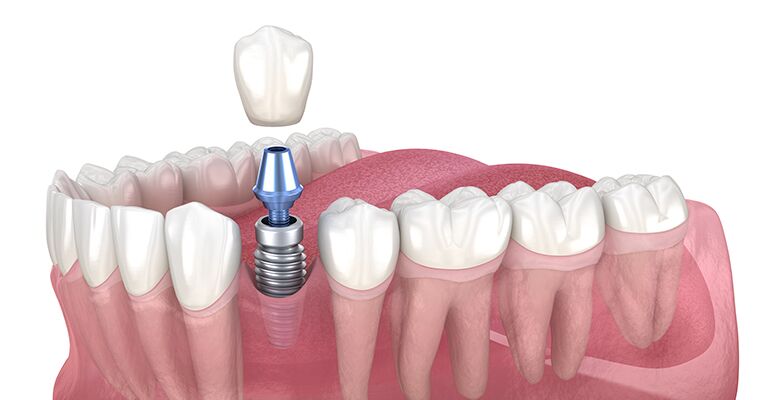 Are Dental Implants Permanent?